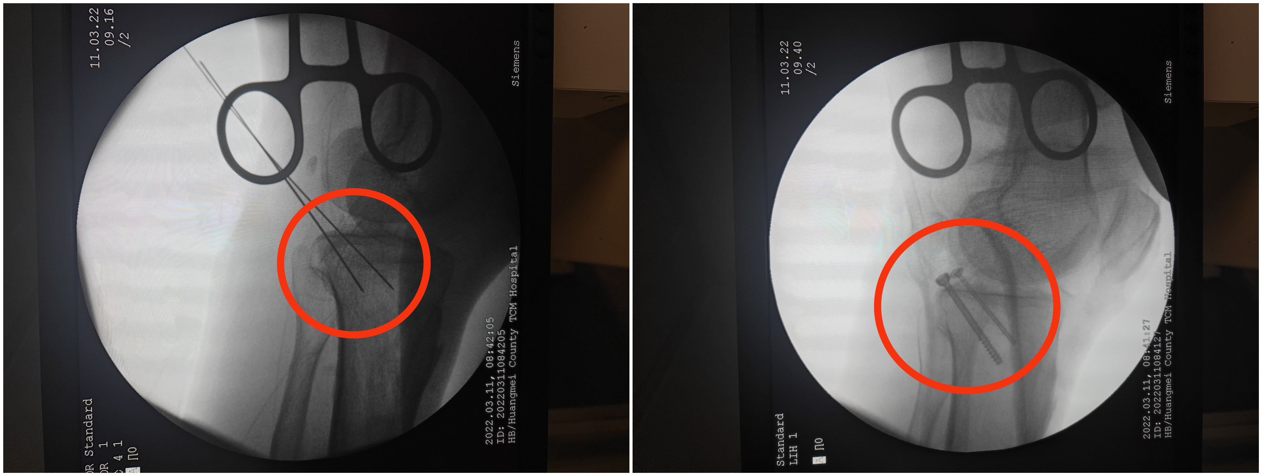 骨伤微创手术,黄梅县中医医院骨伤一科