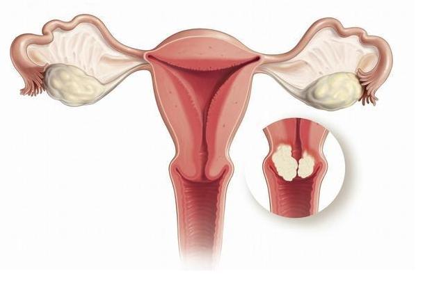 21岁女子确诊宫颈癌痛哭自责,23岁女子外阴癌前病变