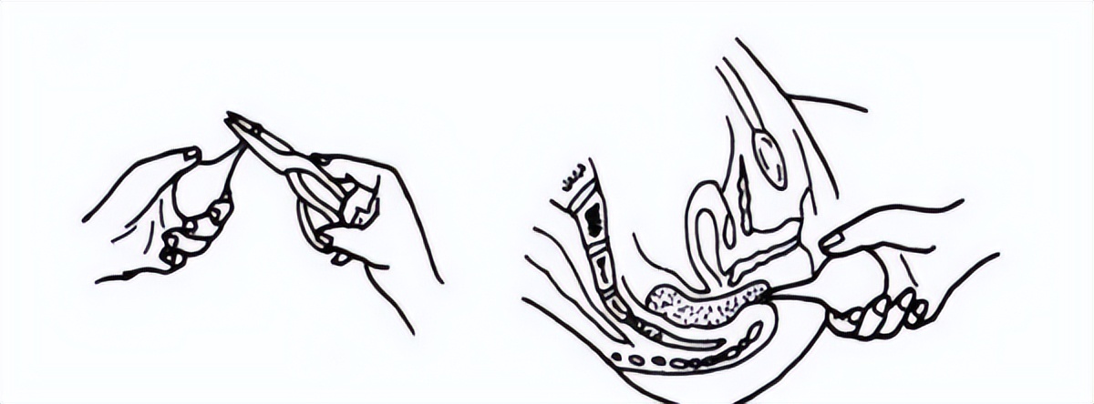 便秘经常用开塞露怎么样啊,一便秘就用开塞露