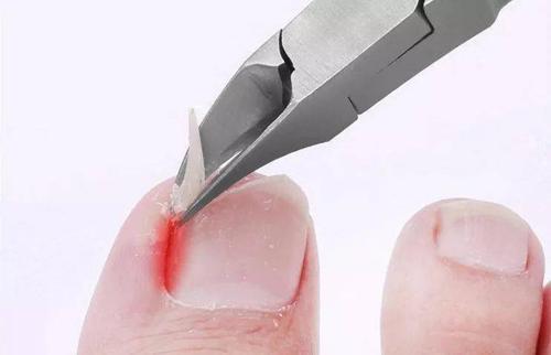 脚趾甲总往肉里长还疼是什么原因,脚趾甲老是戳到肉