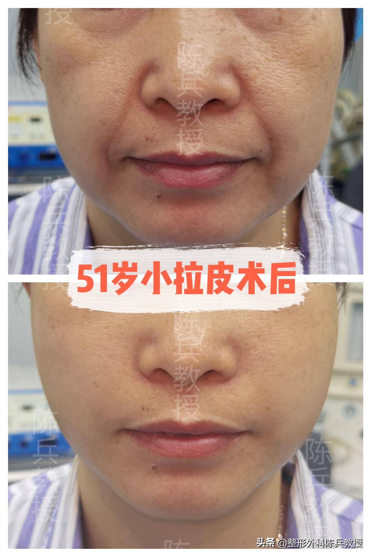 线雕面部提升跟拉皮哪个效果好,面部线雕和面部拉皮应该选哪个好