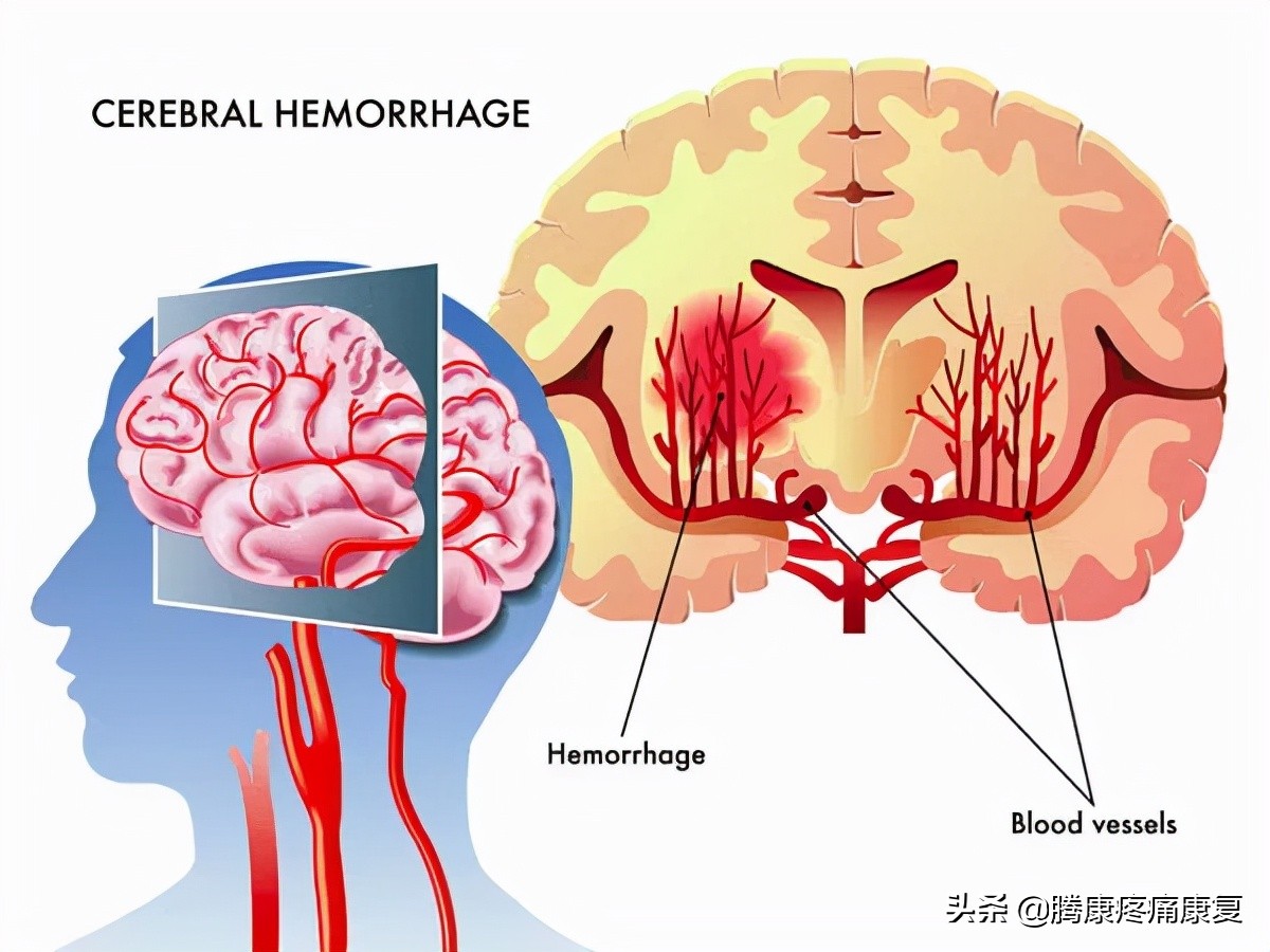 中风偏瘫康复锻炼腿酸困咋回事,中风导致的偏瘫的自我康复锻炼