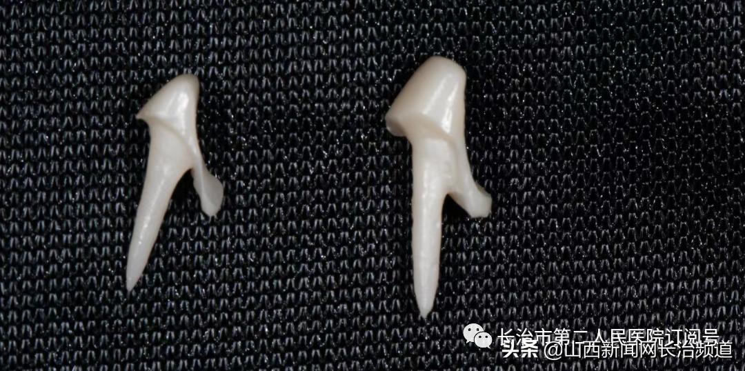 门牙牙齿摔断了一半怎么处理,长治二院医生牙齿掉了怎么办