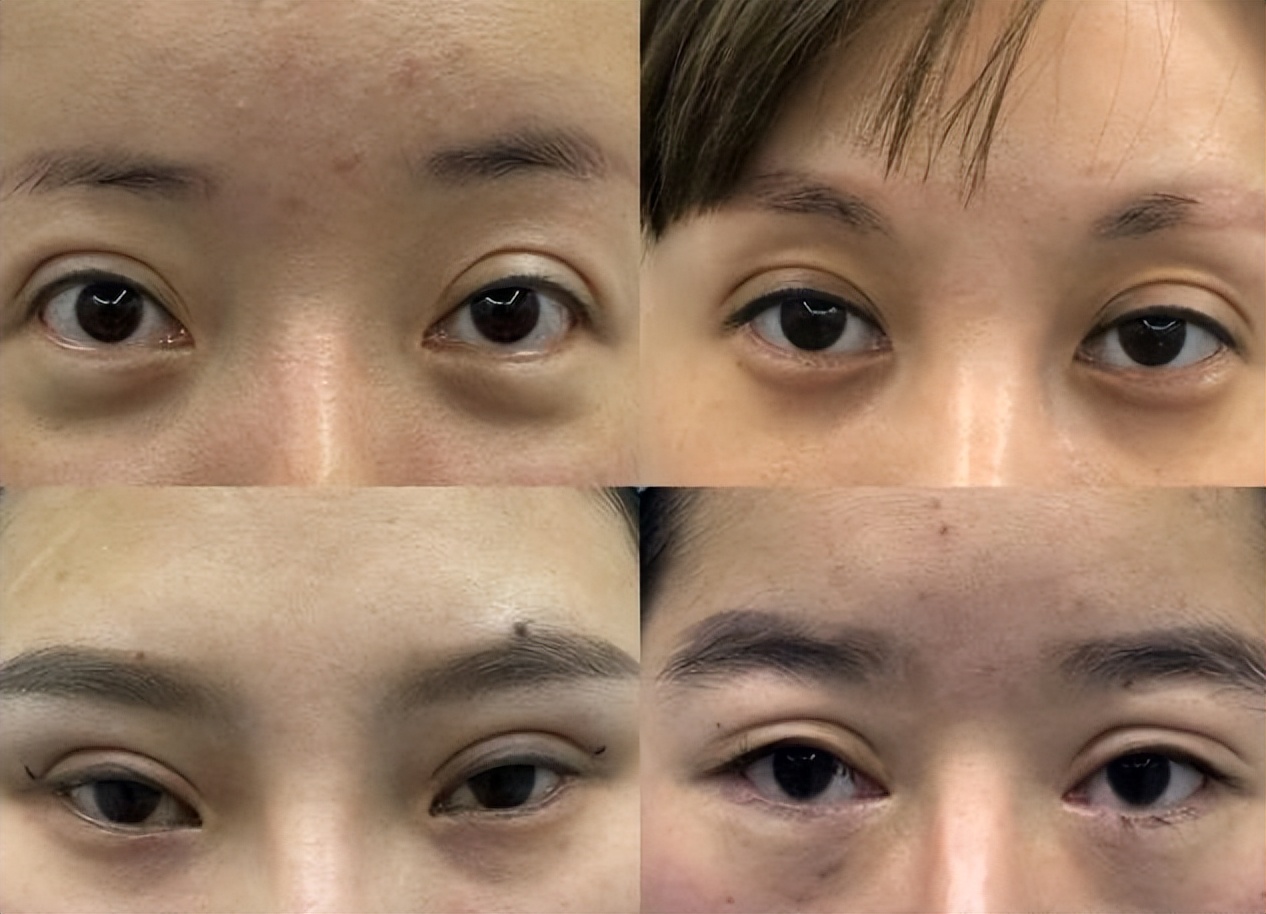 双眼皮手术前后干货,眼皮凹陷割双眼皮十个有九个后悔