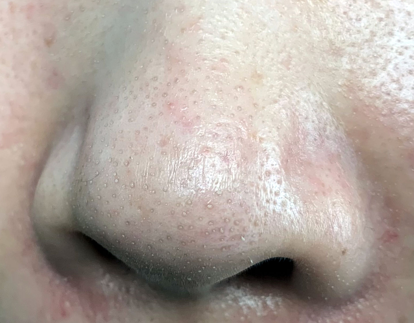 鼻头长黑粉刺怎么回事图片,鼻梁及两侧起了闭口粉刺