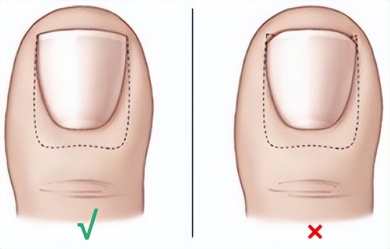 指甲长进肉里,手指甲长进肉里怎么办