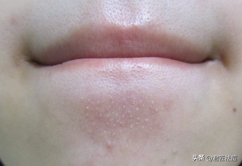 脸上都是闭口粉刺怎么改善,闭口粉刺和闭口粉刺的区别