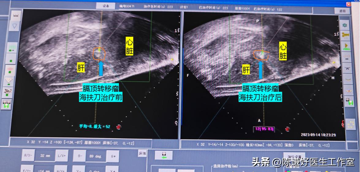 晚期胰腺癌肝转移海扶刀治疗病例（胰腺癌系列19015例）