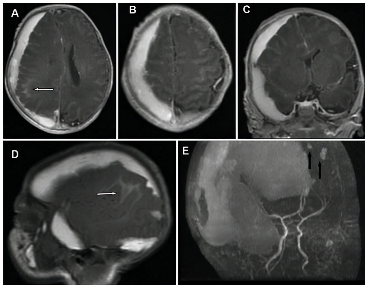 孕期肚子被撞了一下轻微出血,孕妇血肿20毫米危险吗
