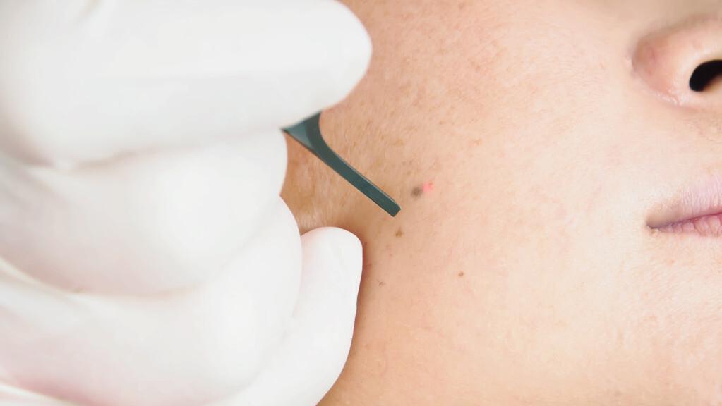 红霉素软膏可以去除老年斑吗,红霉素加阿司匹林老年斑一擦就掉