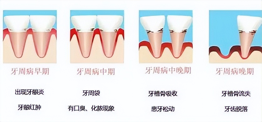 牙缝间牙结石怎样清除干净,牙缝表面的牙结石怎么洗掉