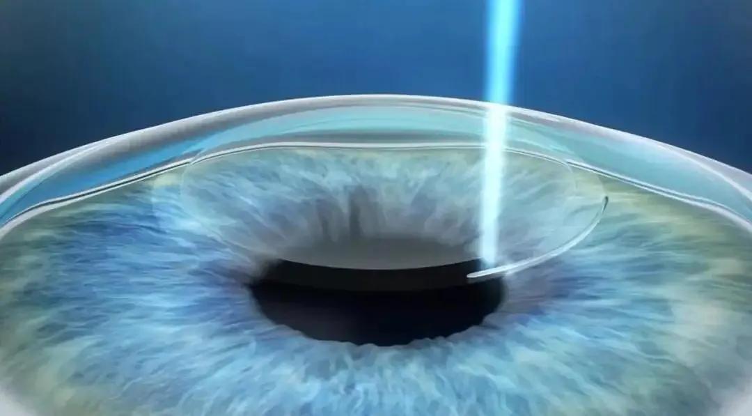 近视手术后还会再近视吗,做完近视手术后会不会再近视