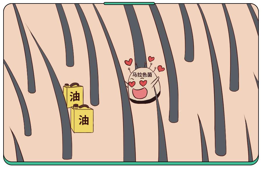 头皮屑是不是因为洗发水的原因,头皮屑多掉发和洗发水有关吗