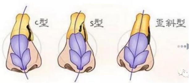 鼻子歪了不通气怎么办,歪鼻矫正改善通气