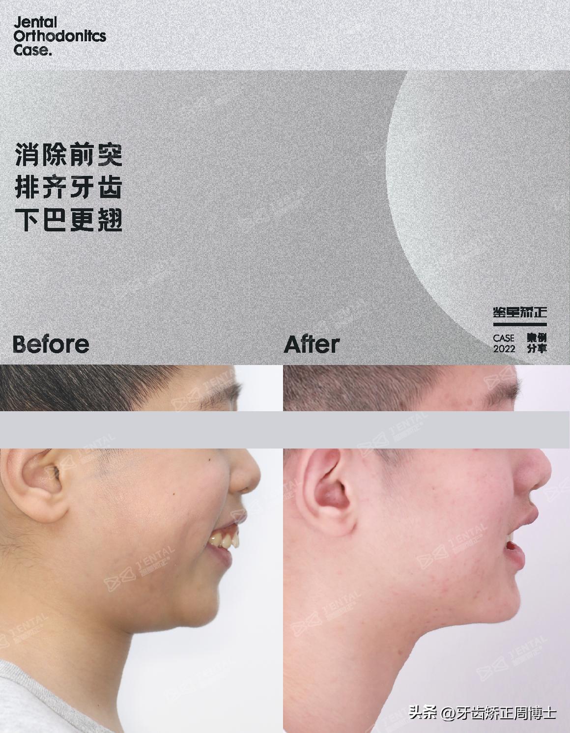 mrc戴上后不能闭上嘴怎么办,mrc矫正能用到几岁