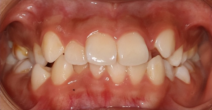 暑期牙齿矫正黄金季,牙齿矫正省钱攻略