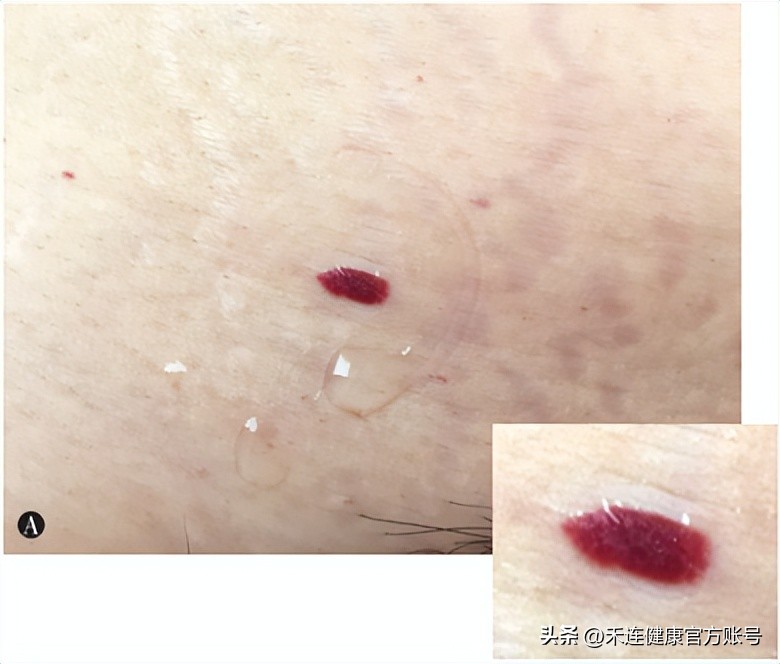 皮下鲜红色小点不痛不痒按压褪色,红色小点按压不褪色