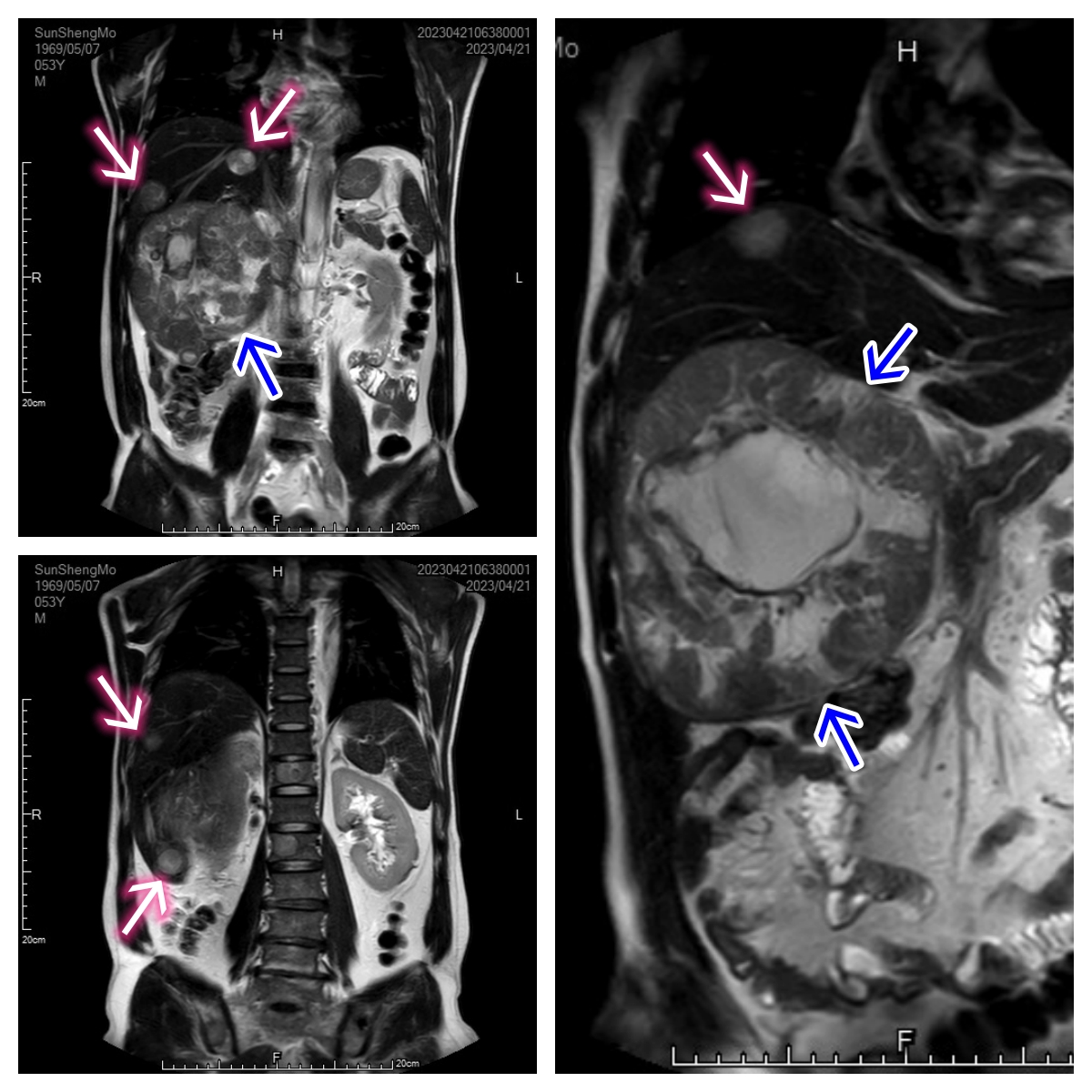 介入栓塞联合靶向,介入联合靶向能消除癌栓吗