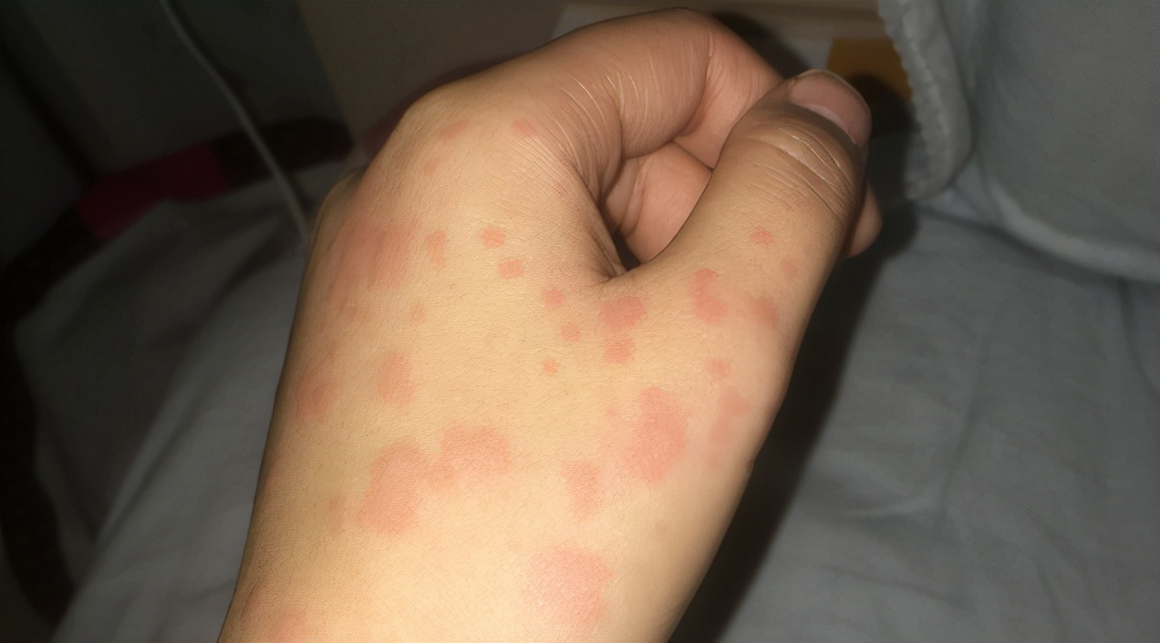 麻疹原因,麻疹存在的主要问题