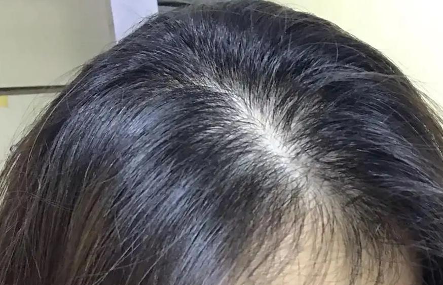 女生容易掉头发什么原因,怎样有效缓解掉发