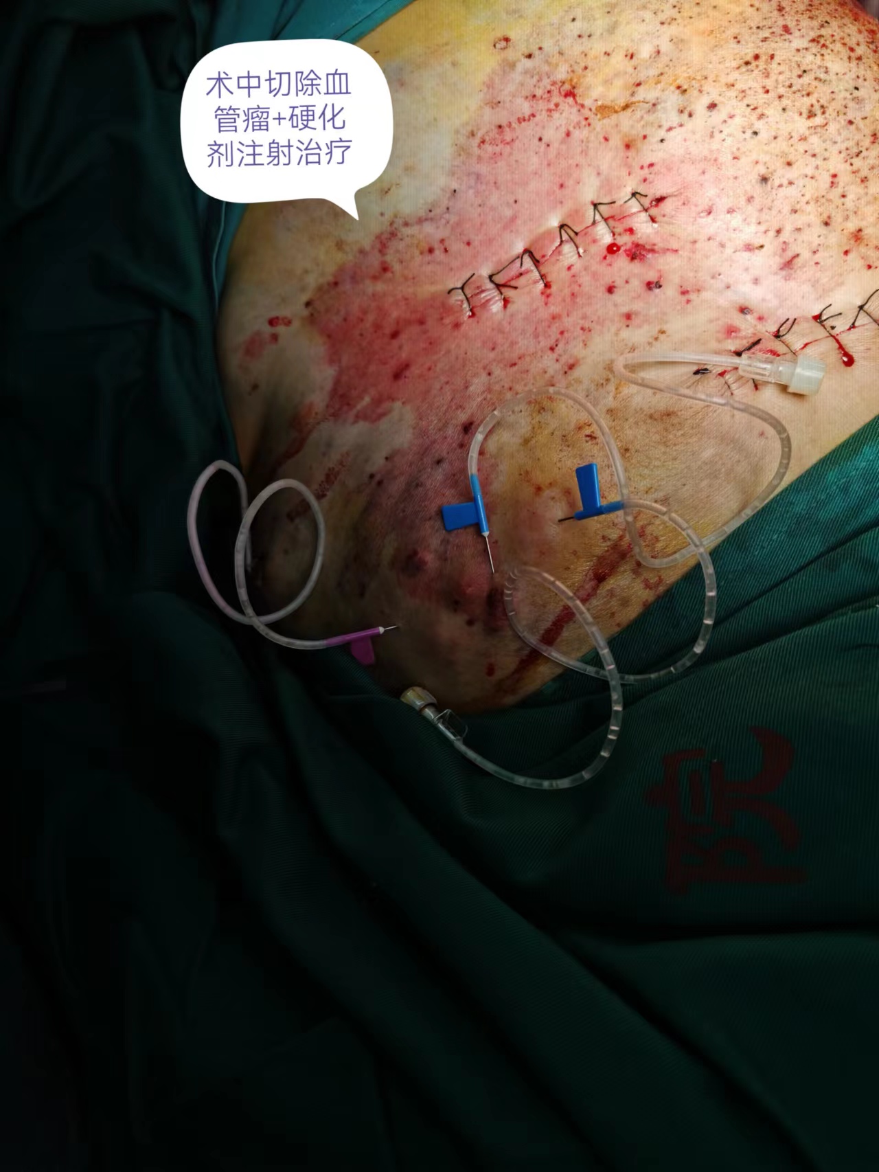 兰州二院血管瘤,兰州第二人民医院雁滩分院怎么样