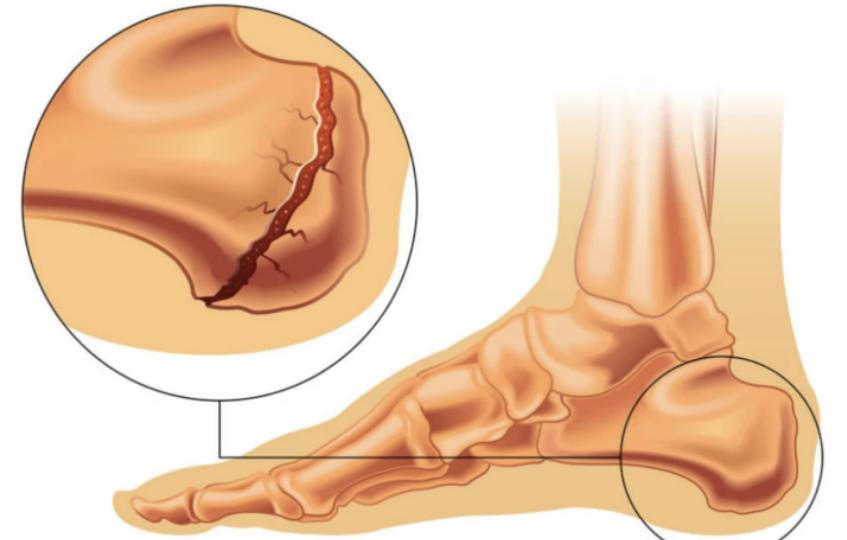 脚后跟疼的原因和治疗的方法,引起脚后跟疼痛的常见11种疾病
