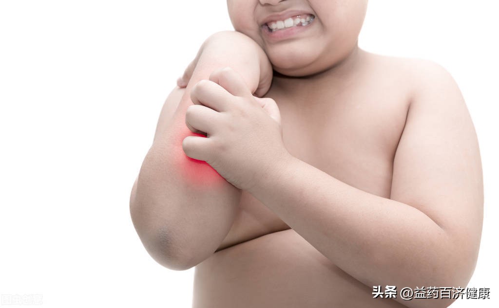 卡泊三醇可以治银屑病吗,他卡西醇能治疗银屑病吗