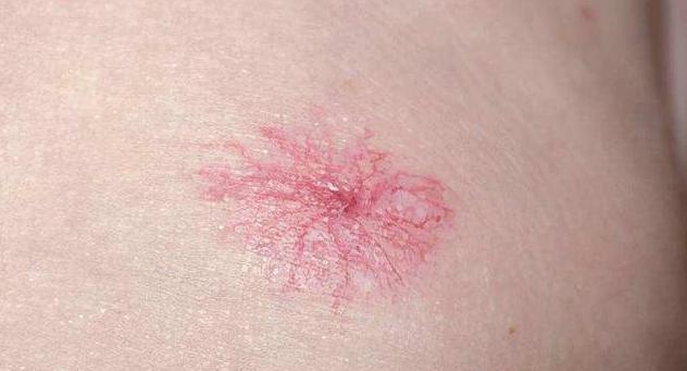 喝酒造成的肝损伤怎么办,喝酒引起的肝掌戒酒多久可以恢复