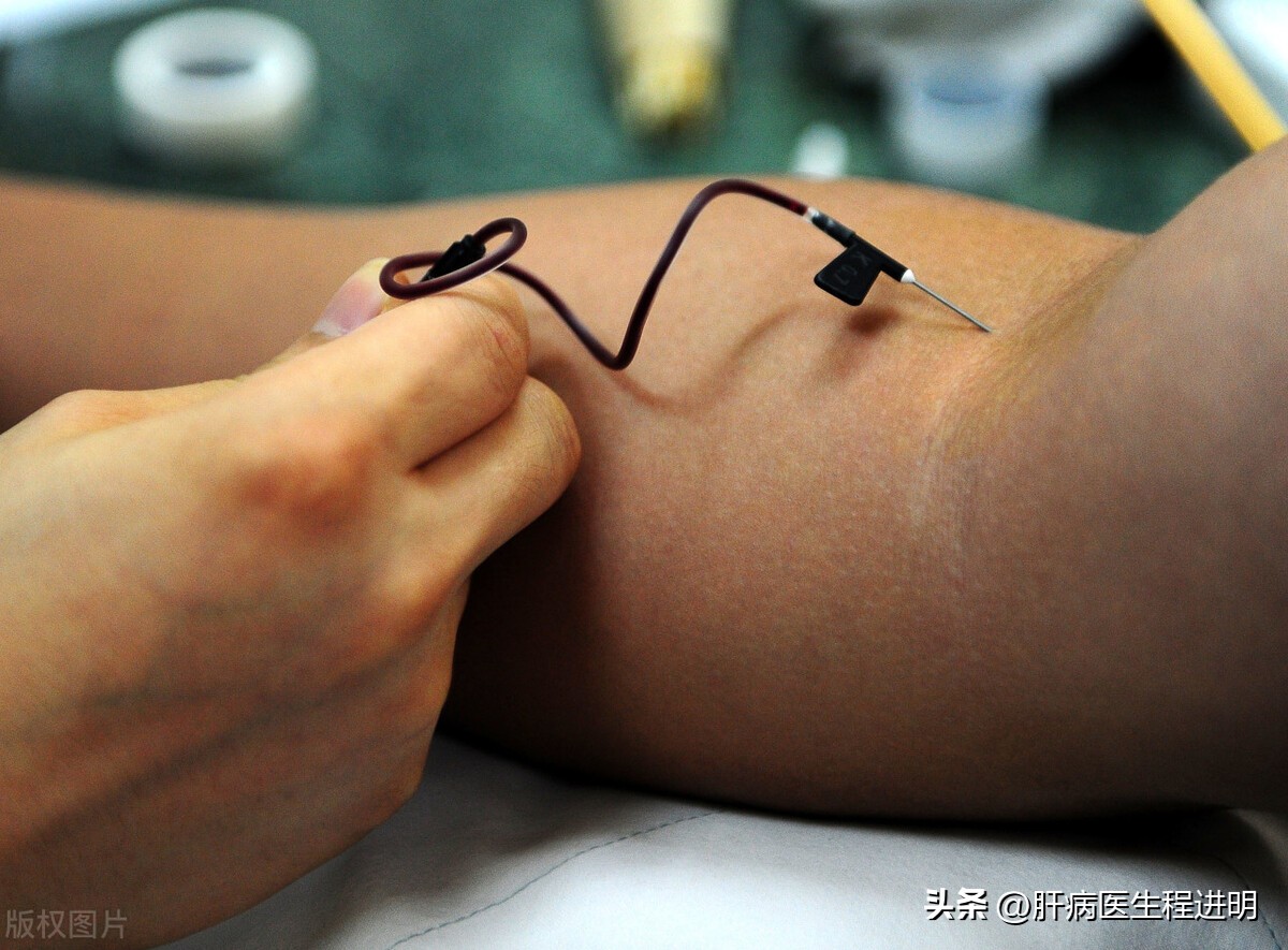 一位肝腹水患者的康复案例,我的肝硬化治疗经验分享