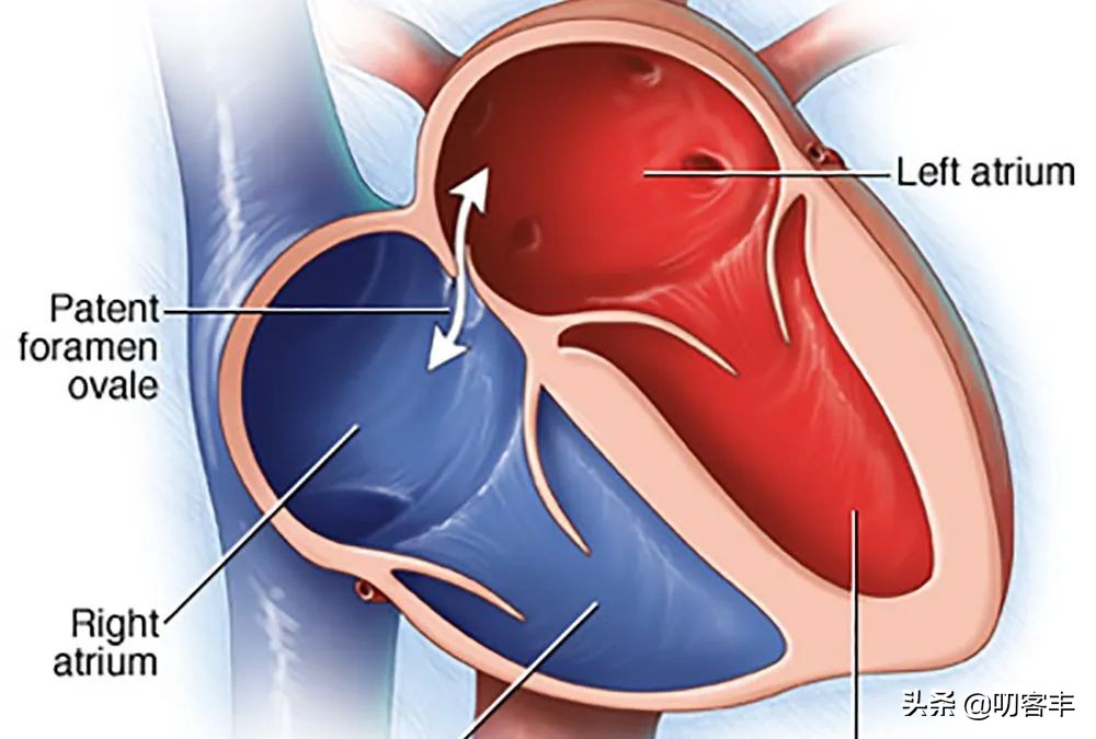 什么是卵圆孔未闭合呢,什么是卵圆孔未闭