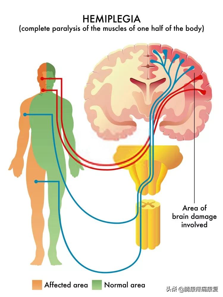 中风偏瘫康复锻炼腿酸困咋回事,中风导致的偏瘫的自我康复锻炼