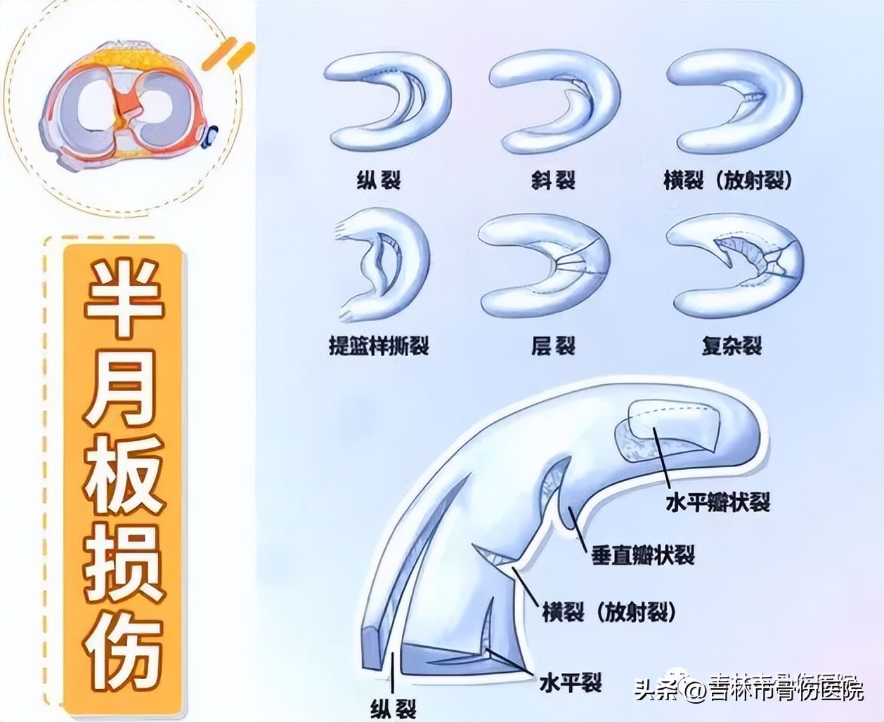 膝盖突然卡住了不能动是怎么回事,膝盖突然卡住怎么复原