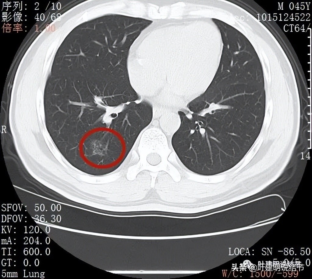 肺蜂窝状改变是肺癌吗,肺部陈旧灶与肿瘤怎么确诊