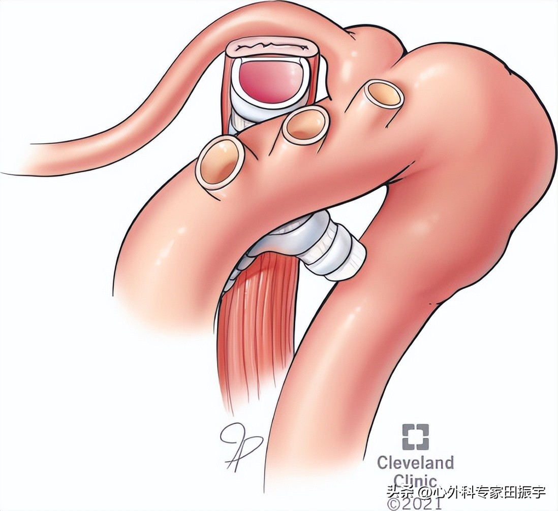 Kommerell憩室和迷走型锁骨下动脉修复术