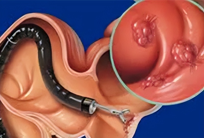 宫颈息肉有必要割掉吗,宫颈息肉需不需要割掉