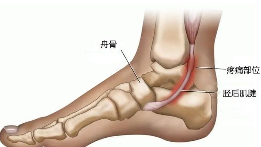 太马来了，跑友们要注意足踝部的运动损伤！