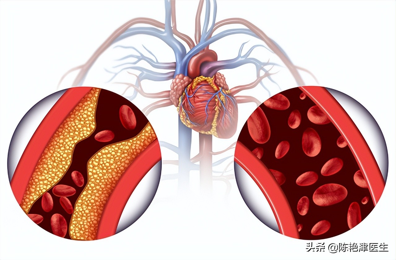 医生测血脂,医生一步一步教您看血脂