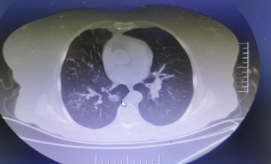 肺小结节诊疗科普,肺小结节怎么治疗最好