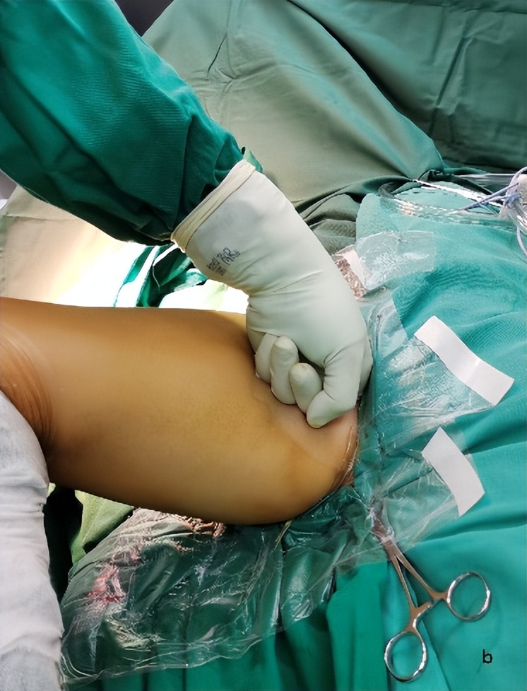 北京积水潭医院脊柱微创视频,北京积水潭医院矫形骨外科