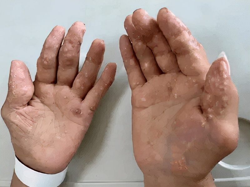 痛风老人吃哪种止痛药好,痛风吃止痛药有什么坏处