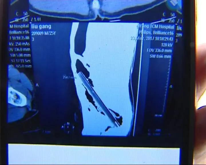 山东一小伙被捅,山东一小伙被捅19刀