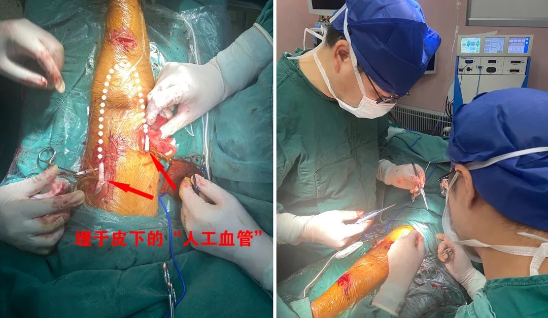 血管造瘘透析,血管人工搭桥