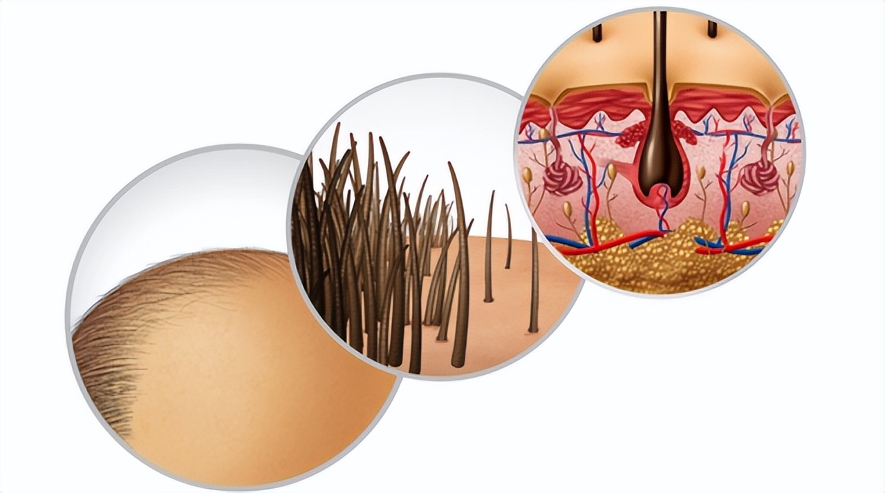 头皮上长疙瘩和脓包怎么治,头皮上总是长疙瘩和脓包如何根治