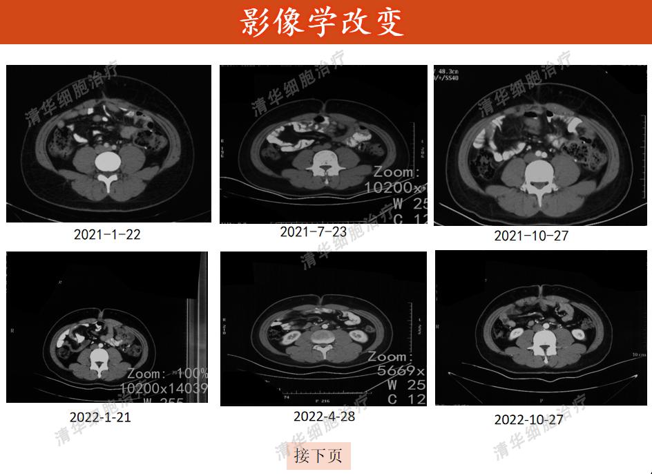 结肠癌术后化疗方案的制定策略,结肠癌手术后热灌注化疗能根治吗