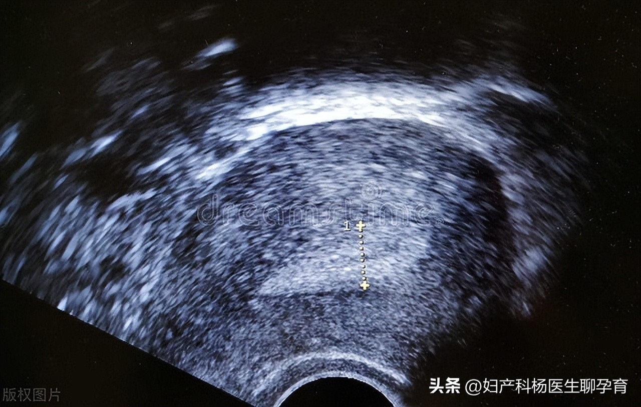 多囊卵巢会影响子宫内膜病变吗,多囊子宫内膜增生严重吗