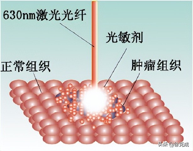 徐克成大讲堂,徐克成谈癌症克星