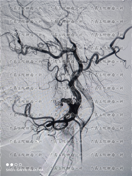 鼻咽癌复发微创手术,恶性鼻咽癌晚期