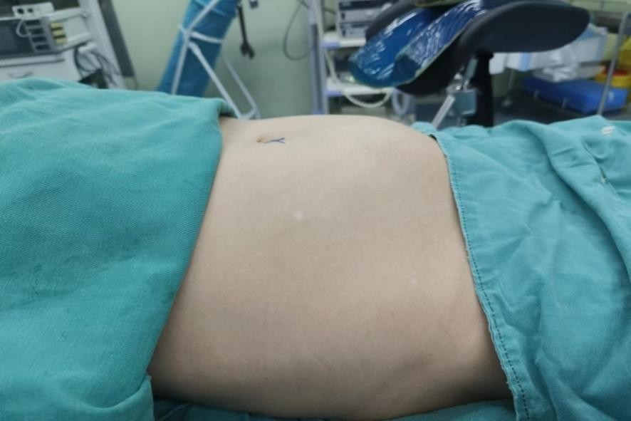 小切口解决大问题——兰大二院西固医院妇科成功完成腹腔镜下巨大子宫全切术