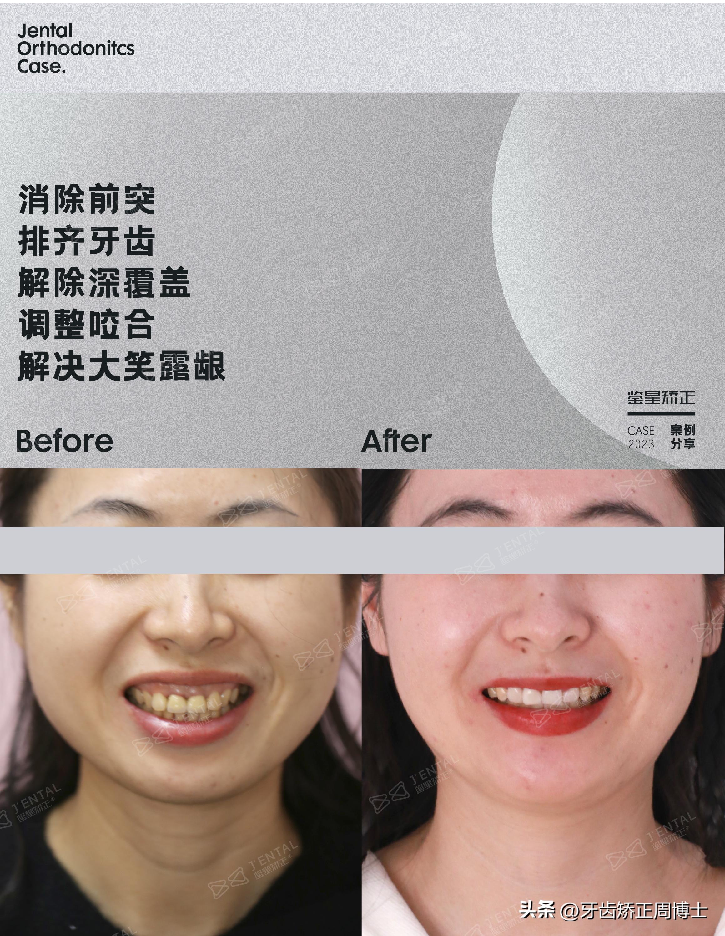 骨性前突下巴后缩可以矫正吗,上颌骨前突下巴后缩如何矫正