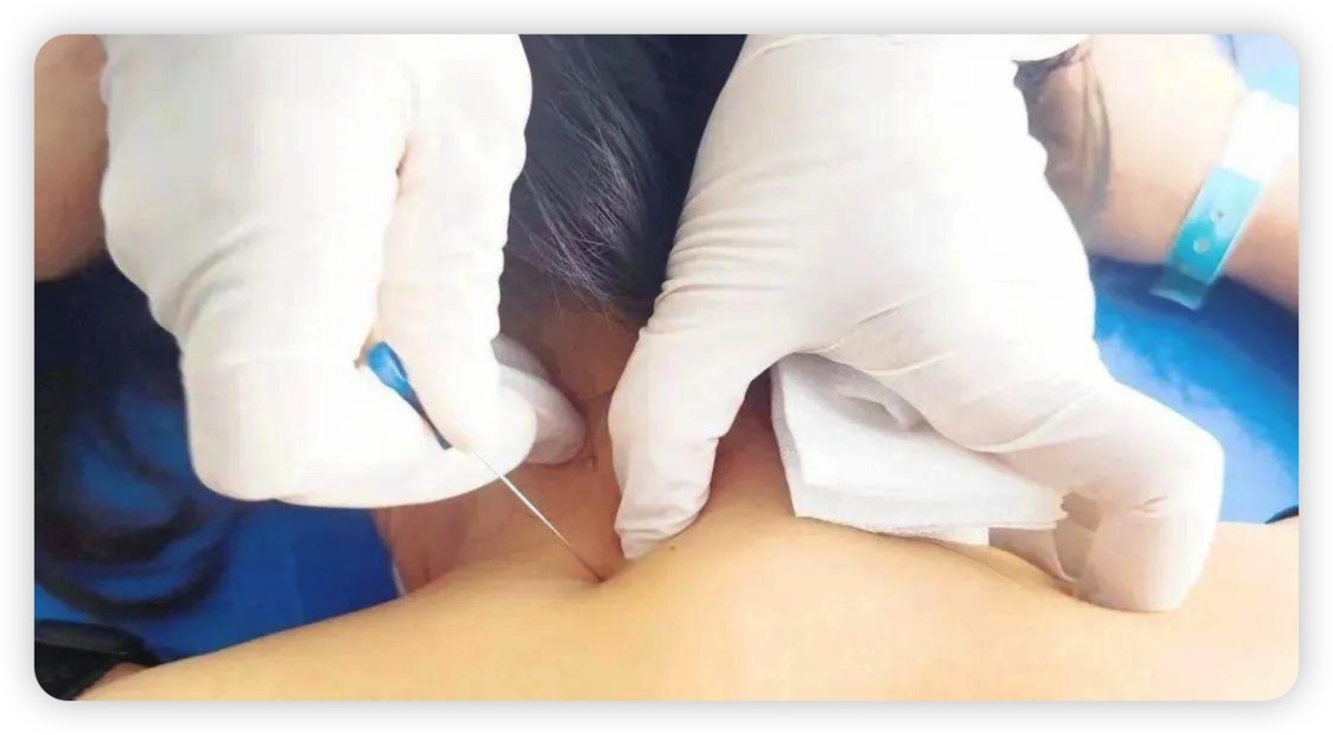 太神奇！腿疼十余年，一“针”下去好大半